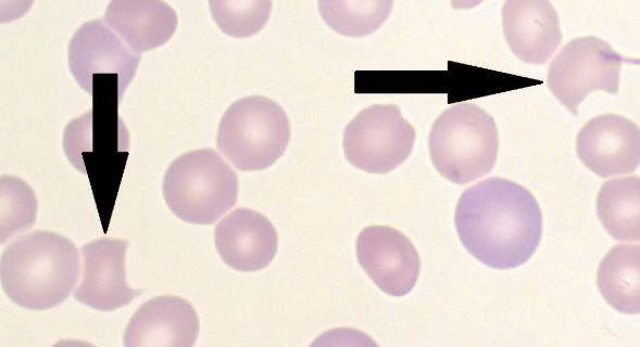 <p>The result in the removal of Heinz bodies in the RBC cytoplasm, causing a pitted golf ball appearance</p>