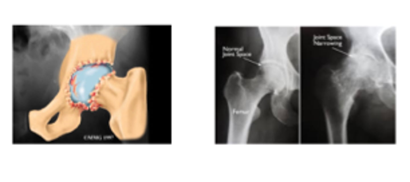 <p>- joint space narrowing<br>- sclerotic subchondral bone<br>- osteophyte at joint margins</p>