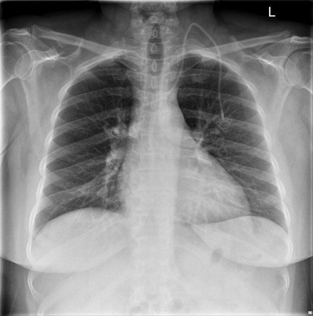 <p>A fully implantable tunneled catheter with a self-sealing internal port and no external tubing.</p>