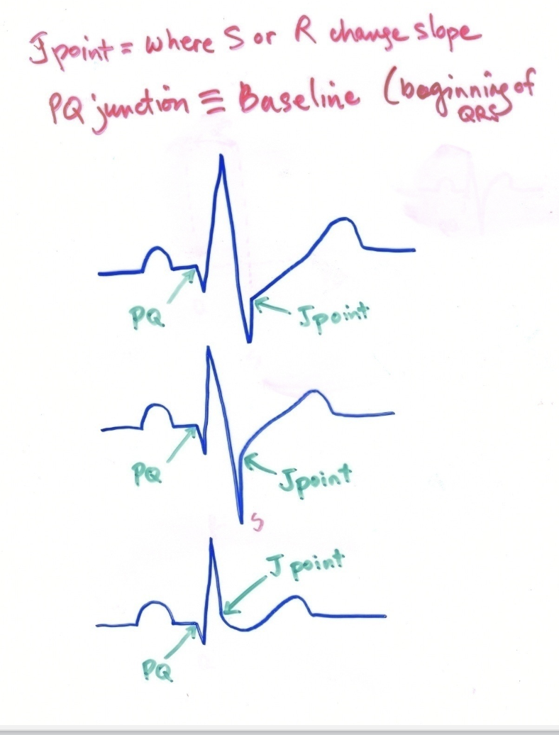 <p>the beginning of the qrs complex; baseline </p>