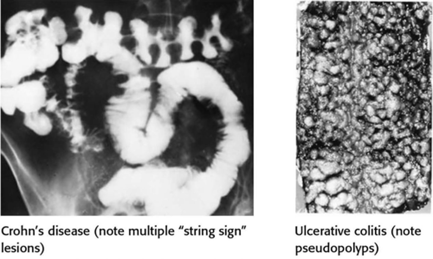 <p>radiograph: for pts with concern for toxic megacolon, warranted to assess for colonic dilation </p><p>small bowel imaging: performed as initial diagnostic workup for pts with suspected CD</p><p>abdominal CT scan: often imaging of choice; thickening is seen in advanced disease</p><p>magnetic resonance enterography (MRE): useful in diagnosing chronic IBD; expensive and time consuming</p><p>transabdominal ultrasound: most sensitive in the ileum and sigmoid/ descending colon</p><p>- new, noninvasive, cheaper, well tolerated; operator dependent, may fail to detect superficial mucosal disease</p>