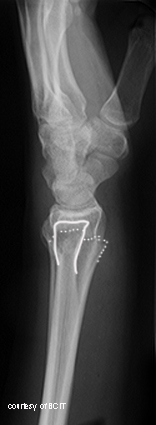 <p>Distal radius fracture with dorsal displacement (“silver fork”), caused by FOOSH with wrist dorsiflexion.</p>