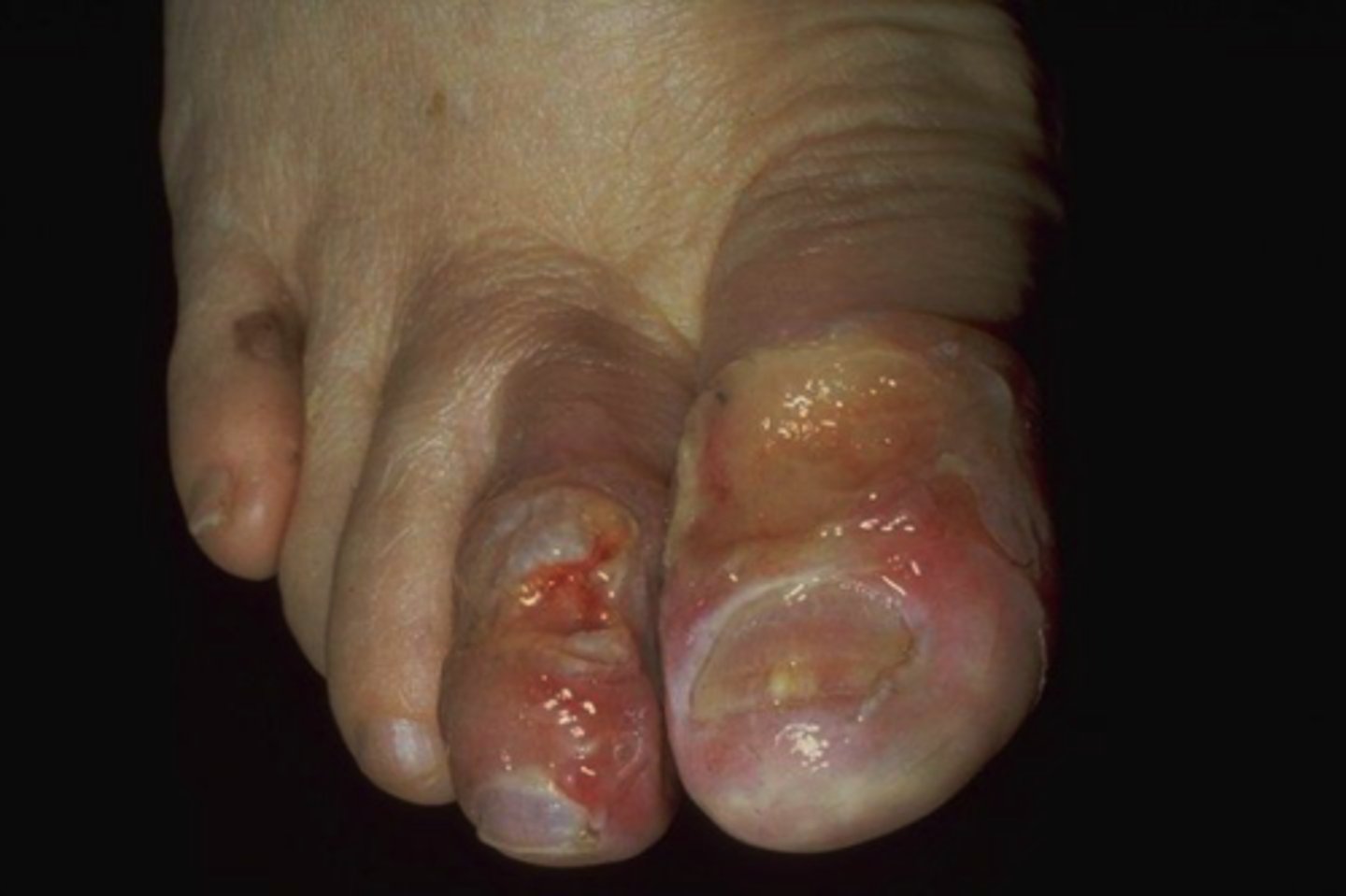 <p>often malodorous and the line of demarcation between live and dead tissue is unclear until the infection is arrested</p>