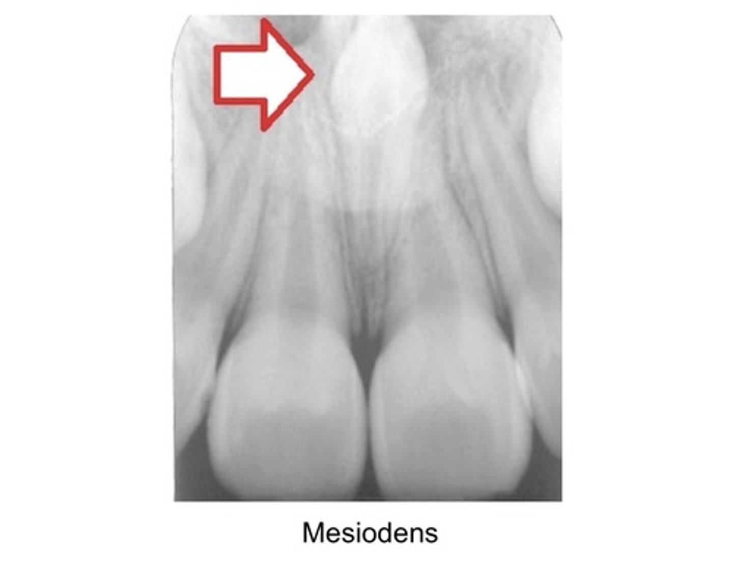 <p>Mesiodens</p>