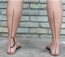 <p><span>This image shows calcaneal valgus or varus?</span></p>