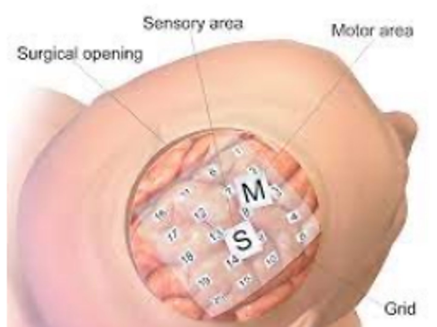 <p>- one single electrode inside the brain</p><p>- good spatial and temporal resolution: can accurately pinpoint both the location ("spatial") and the precise time ("temporal) of brain activity</p>