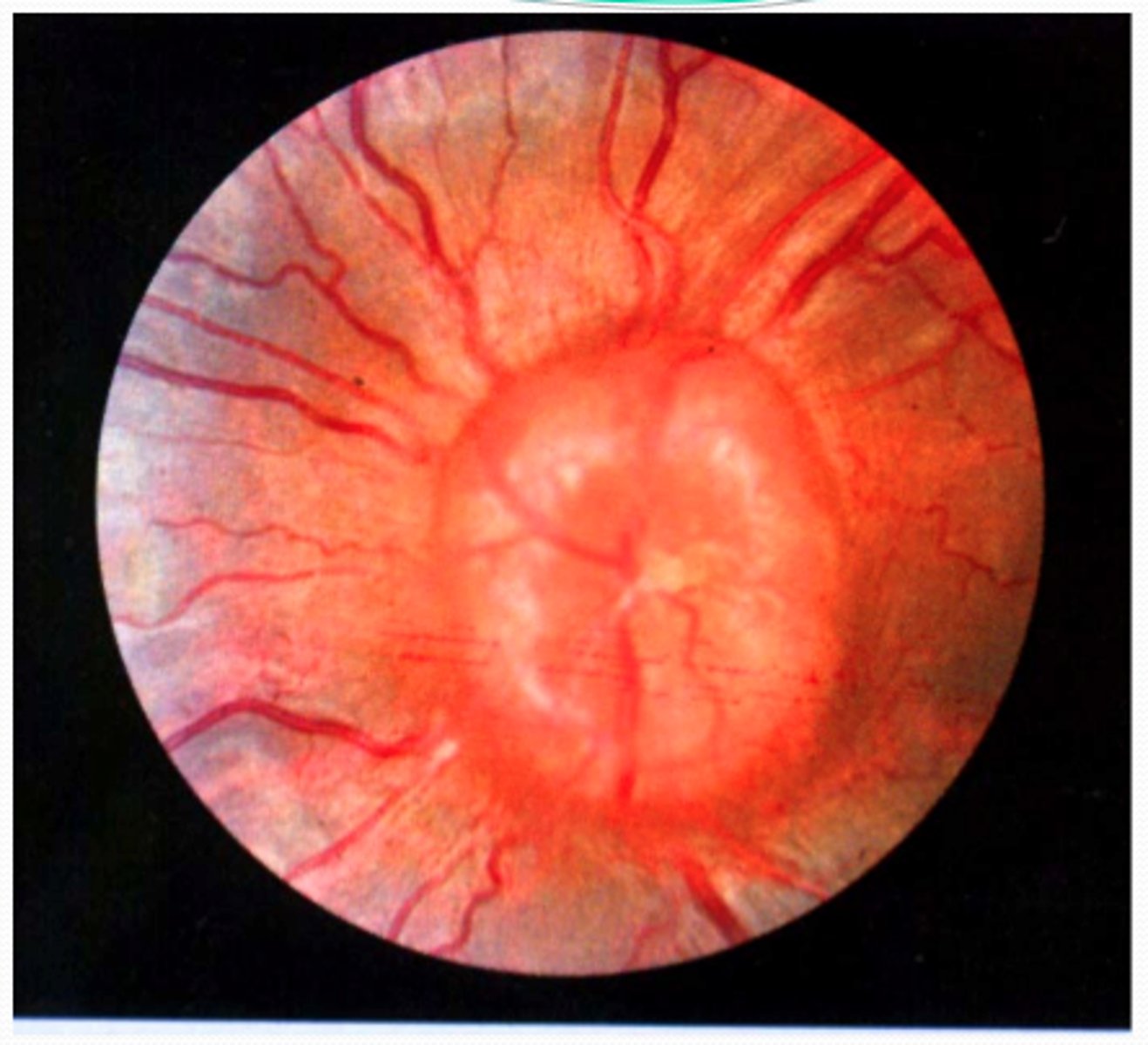 <p>Papilledema</p>