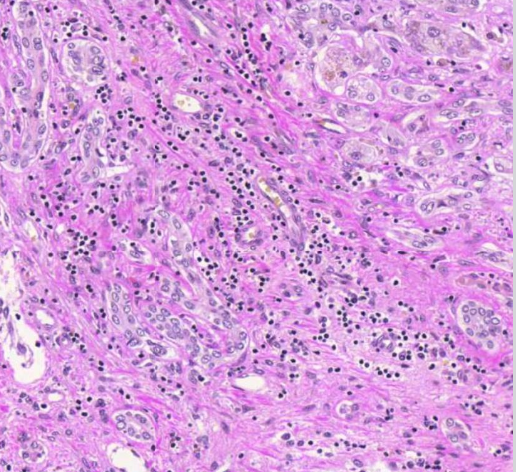 <p>sappitieproliferaatiota ja lievää lymfosyyttilisää</p>