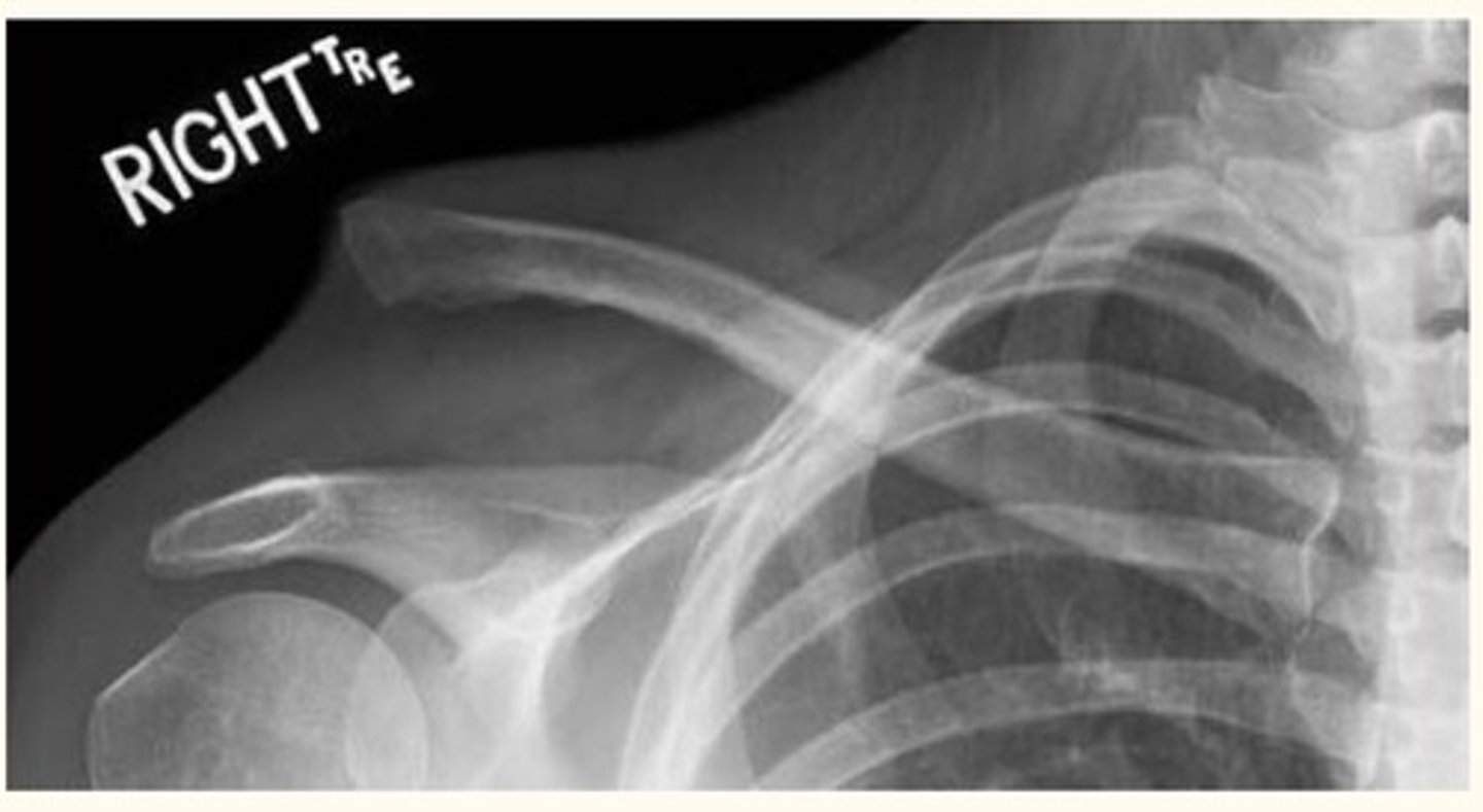 <p>- A traumatic sprain to the AC joint</p><p>- Usually caused by a direct blow to the shoulder (downward force on the acromion process)</p><p>- Grade 1: Mild, grade 2: moderate, grade 3: severe</p>