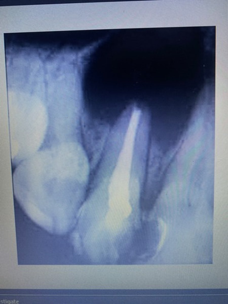 <p>Radicular cyst</p>