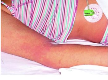 <p><span><span>Staphylococcus aureus infection</span></span></p><p>Caused by toxic shock syndrome toxin-1<u> TSST-1</u> (superantigen); results in high fever, rash, low BP, multi-organ failure.</p><p>it is associated with tampon use surgical wounds and skin infections.</p>