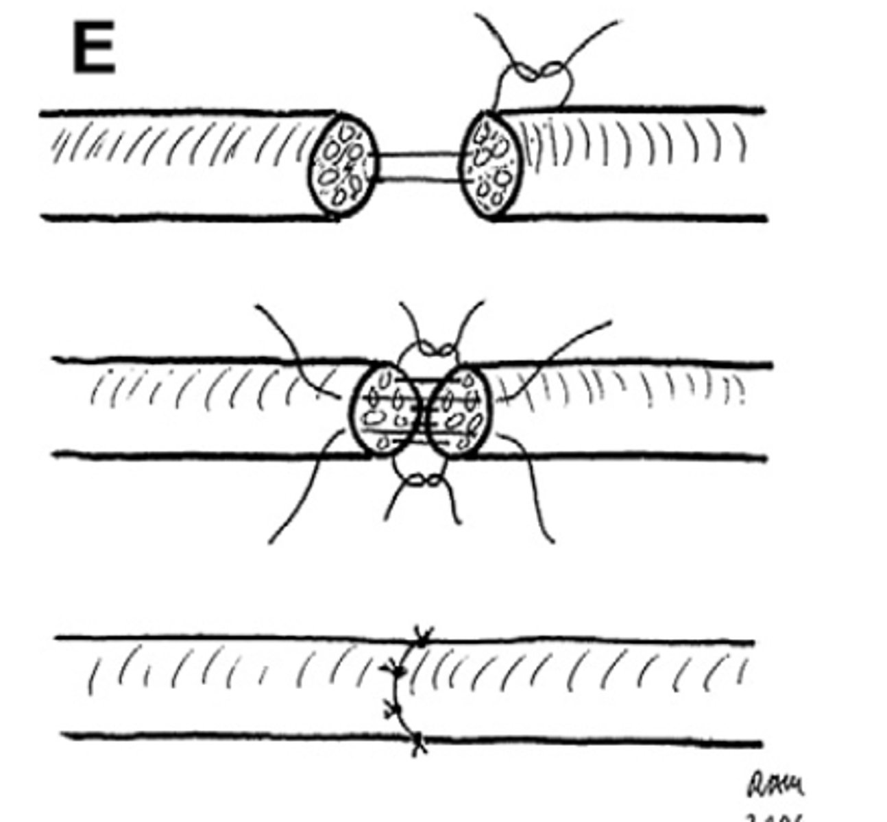 <p>nerve transection i.e. direct visualization of nerve severance during surgery</p>