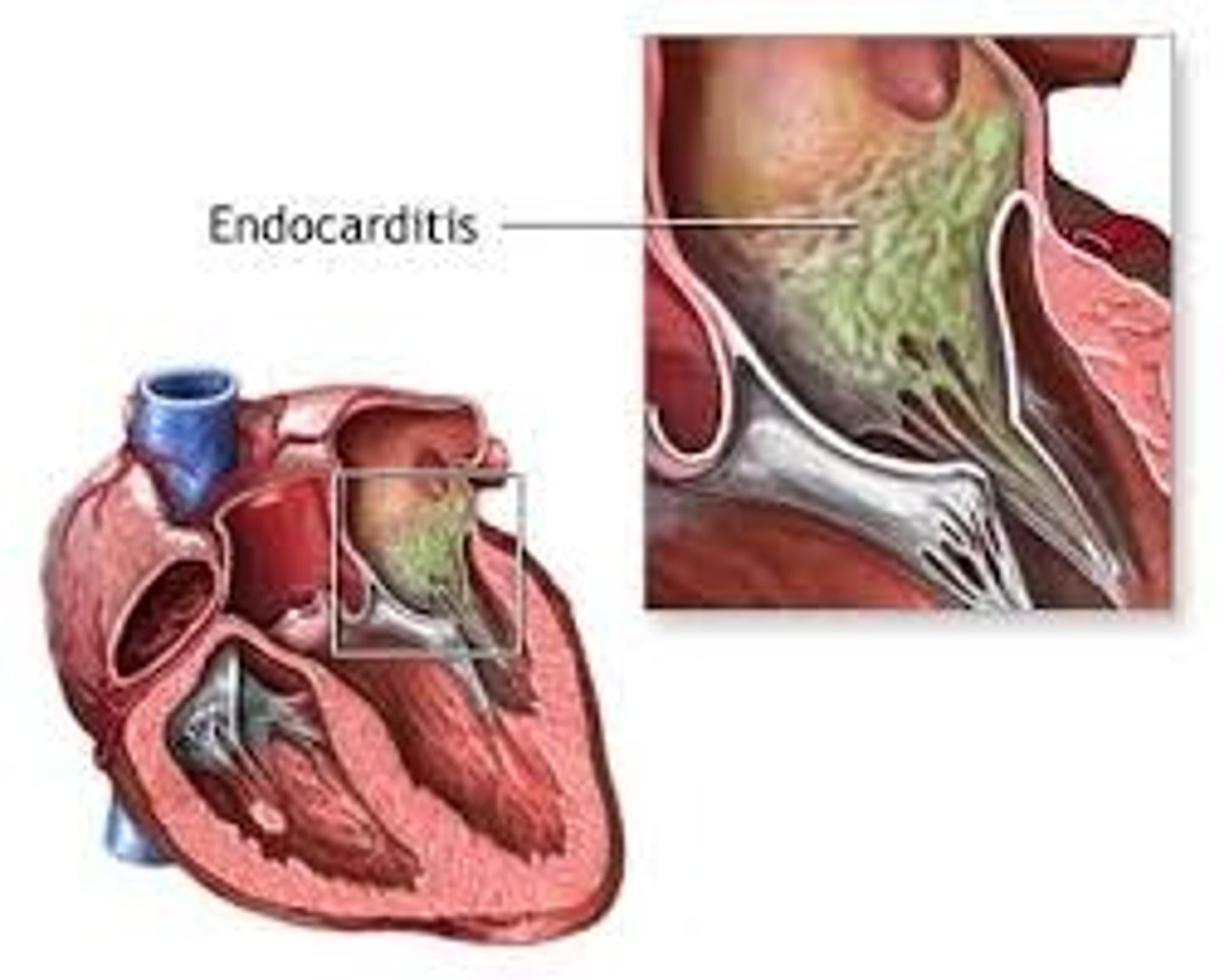 <p>inflammation of the inner lining of the heart</p><p>*typically a valve issue</p>