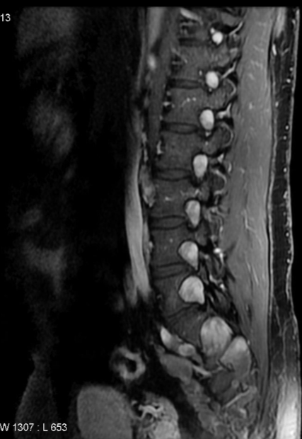 <p>what is seen here for this case of neurofibromatosis type 1?</p>