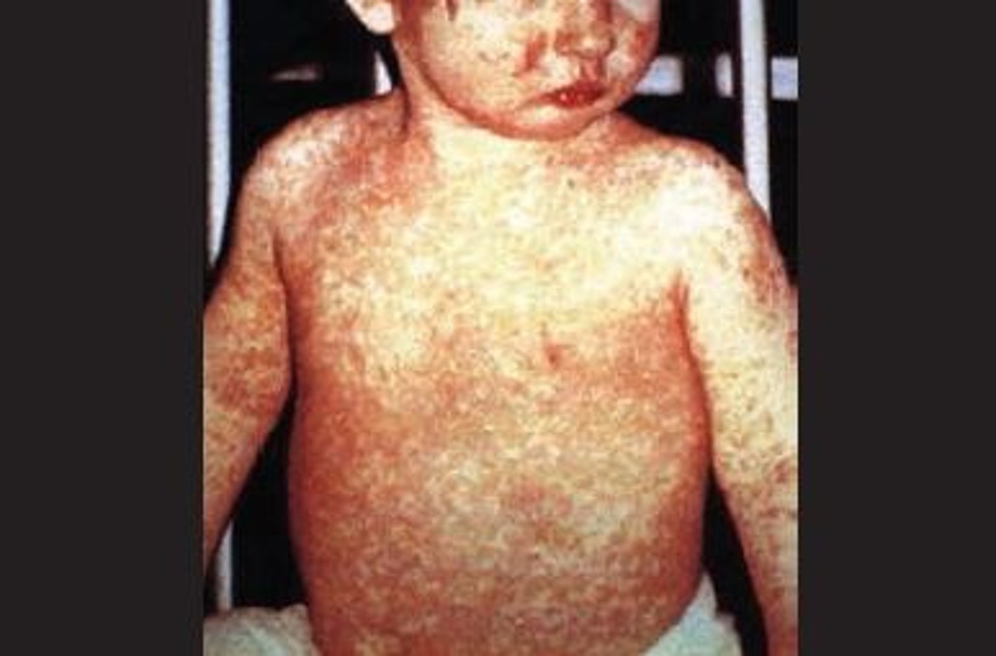 <p>Caused by measles virus (Measles morbillivirus, MeV)</p>