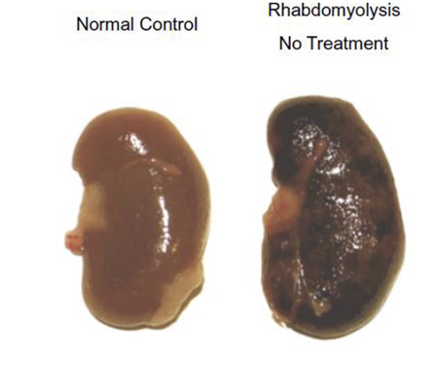 <p>Direct or indirect severe muscle injury (e.g., trauma, statins, excessive alcohol) and release of myoglobin into the blood</p><p>Symptoms:</p><p>- Excessive muscle pain, muscle weakness</p><p>- Dark red or brown urine</p><p>- Serum creatine kinase and myoglobin are elevated</p><p>Complications: Acute renal failure, fatal heart rhythm disturbances, hypovolemic shock, disturbances of electrolyte balance, metabolic acidosis, hyperthermia, compartment syndrome</p><p>Overall mortality rate is ~5%</p><p>Treatments:</p><p>IV fluids</p><p>Fasciotomy</p><p>Stop drug use (if applicable)</p>