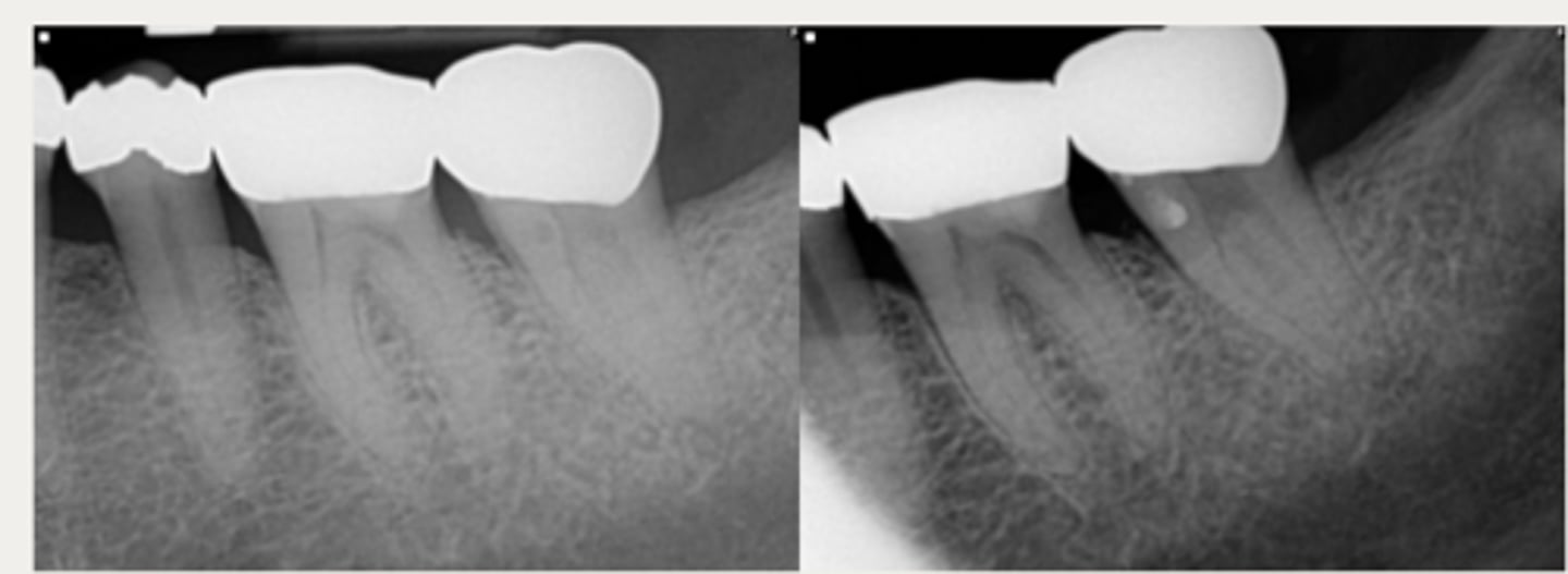 <p>These are a part of which treatment for External Cervical Resorption (ECR)?</p><p>For lesions that are accessible through raising a flap and that are unlikely to have pulpal involvement after removal</p><p>- Raise a flap</p><p>- Complete debridement of the resorptive lesion</p><p>- Tx with 90% trichloroacetic acid (TCA) or 5.25% NaOCl</p><p>- Restoration of defect with resin-modified glass ionomer (Geristore) or Biodentine</p><p>- Flap closure and suturing</p>