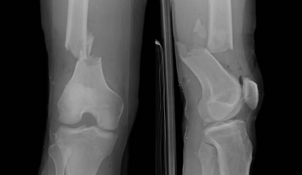 <p>a fracture resulting in bone splinters</p>