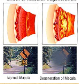 <p><span style="color: #000000">Macular Deg</span><span>eneration (ARMD)</span></p>