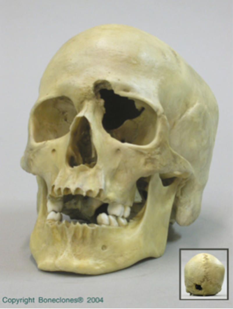 <p><span>What type of trauma caused this injury?</span></p>