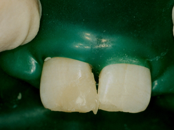 <p>with the matrix removed we can see a little bit of excess&nbsp;</p>