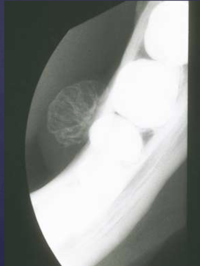 <p>why is the osteoma radiolucent </p>