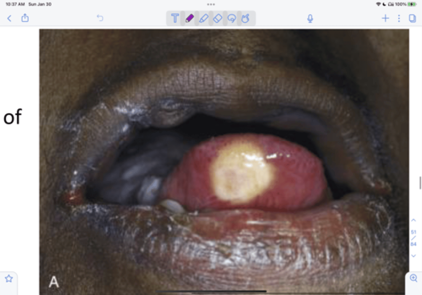 <p>____ ___ tumors are uncommon growths derived from schwann cells where the cytoplasm is granular because of lysosomes. Its most commonly found on the dorsal tongue, it's an asymptomatic sessile nodule that's pink to yellowish in color. It can be treated with conservative local excision with submission of tissue for histopathologic examination and recurrence is rare</p>