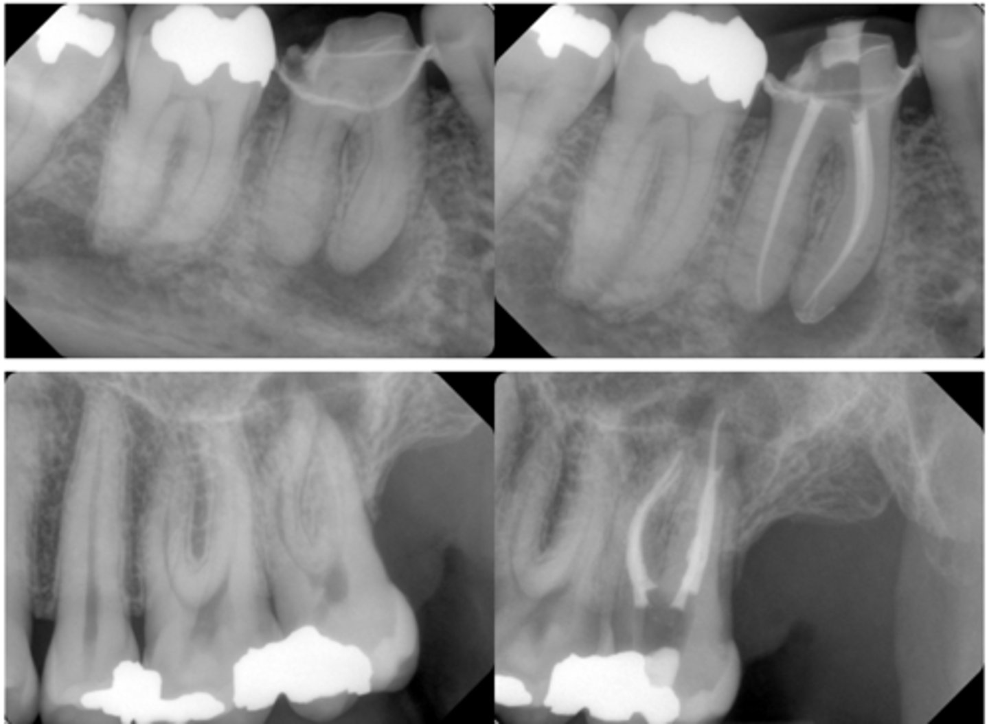 <p>What type of lesion?</p><p>- PARL limited to apical area</p><p>- Crestal bone level and probing depths WNL</p><p>- Pulpal dx: necrotic pulp</p><p>- May have sinus tract (but only in apical location)</p>