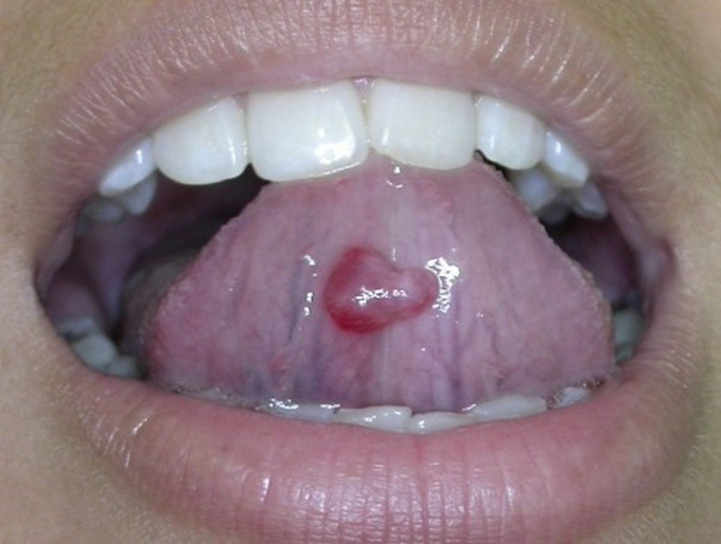 <p>Accessory salivary glands on ventral surface, cyst develops from trauma.</p>
