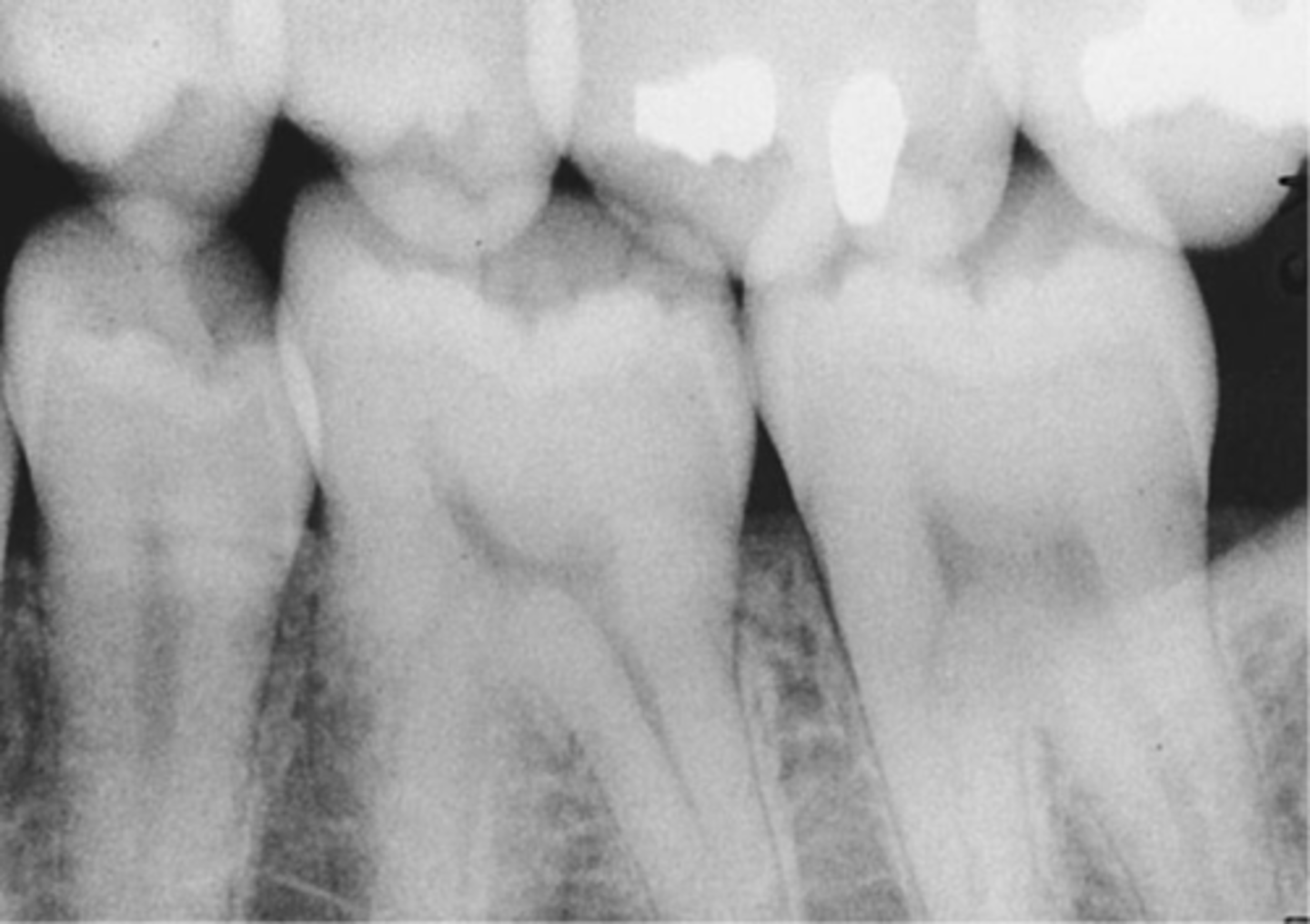 <p>Incorrect vertical angulation.</p>
