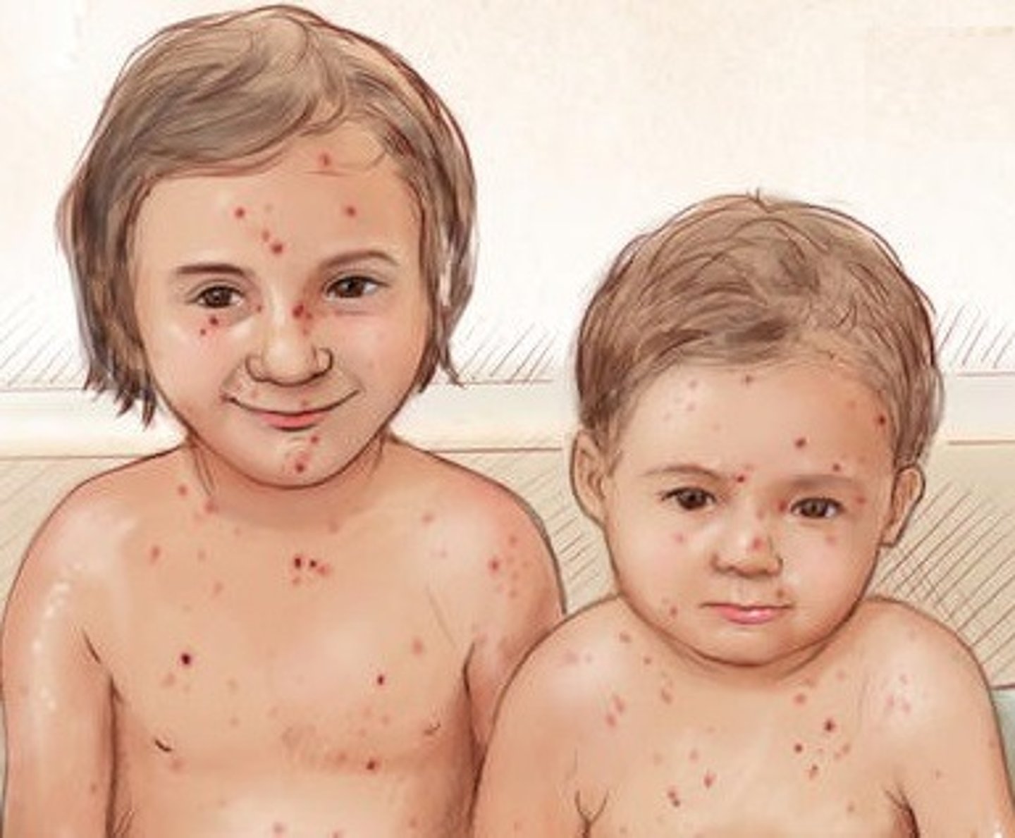<p>chicken pox</p>