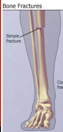 <p><span style="font-family: &quot;Trebuchet MS&quot;, sans-serif">Bone breaks cleanly without penetrating the skin.</span></p>