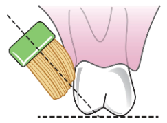 <p><span><strong>• Used to clean around appliances</strong></span></p><p><span><strong>• Bristles placed at a 45-degree angle toward the occlusal or incisal surface of the tooth</strong></span></p><p><span><strong>• Bristles should touch at the junction of the free gingival margin and tooth</strong></span></p><p><span><strong>• Circular vibratory motion is used</strong></span></p>