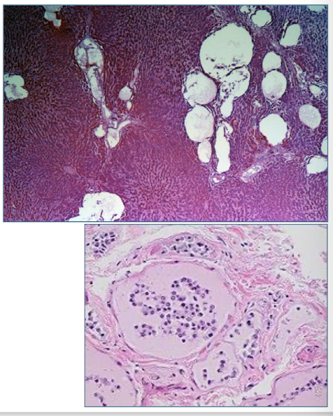 <ul><li><p>tissues pale staining</p></li><li><p>no inflammatory rx</p></li><li><p>cadaver bacilli</p></li><li><p>erythrocytes not preserved</p></li><li><p>loss of tissue pattern</p></li><li><p>cells released from basement membrane</p></li></ul><p></p>