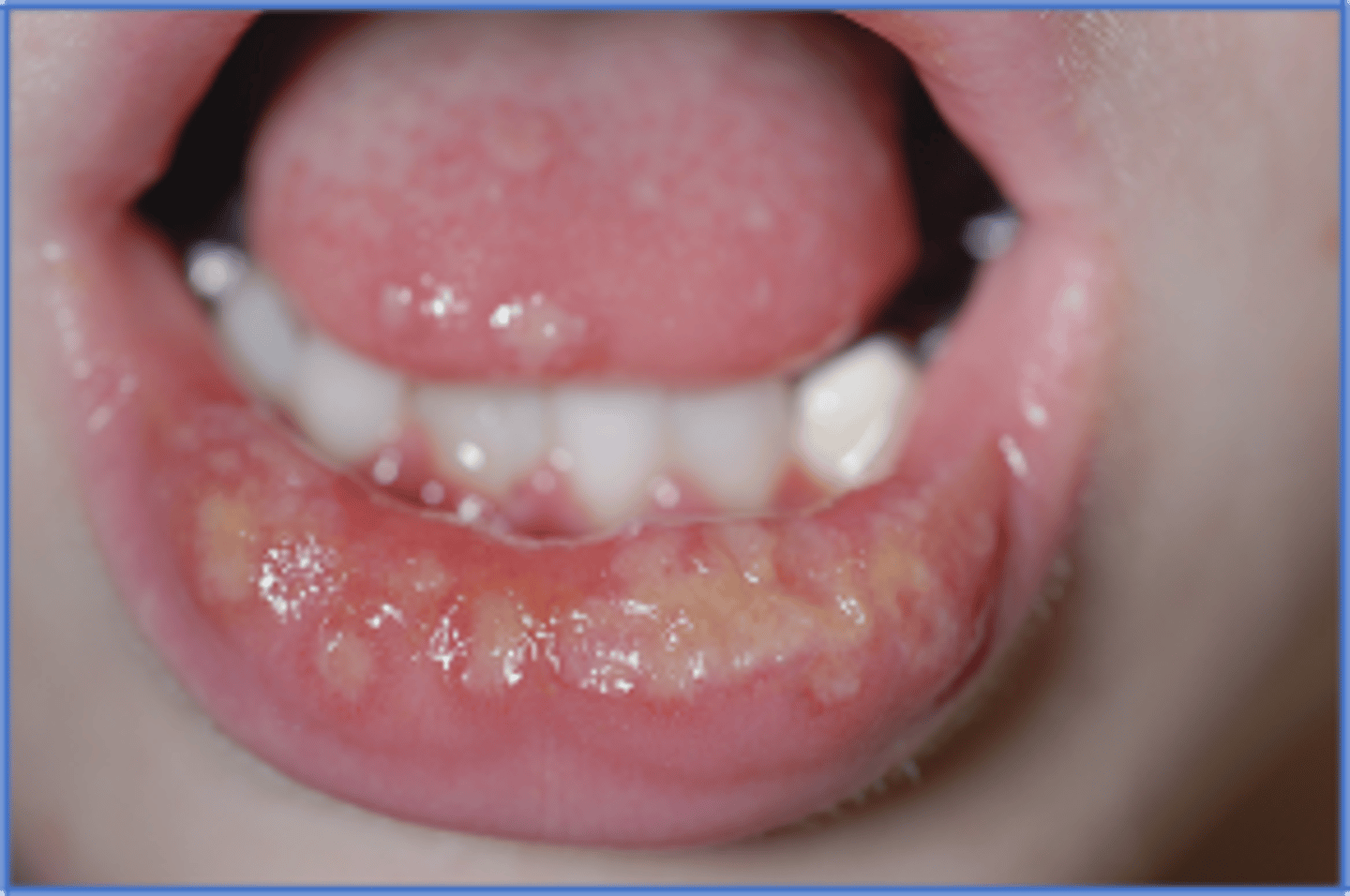<p>-Common and mild in IC; NO TX needed</p><p>-Burning, small vesicles that rupture and scab</p><p>-Found on lips, tongue, buccal mucosa, soft palate</p><p>-Presentation: Painful ulceration, fever, lymphadenopathy</p>