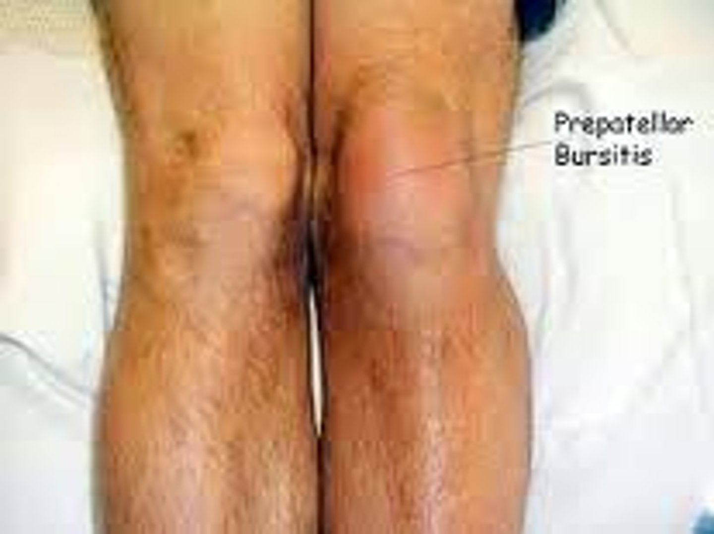 <p>- inflammation of bursa between skin and patella</p><p>- presents with pain, swelling, redness in knee, difficulty moving</p><p>- also can be seen if one has a history of reptive motion, chronic kneeling or falls</p><p>- also known as "housemaids knee"</p>