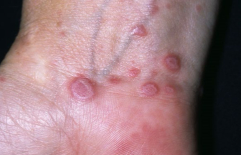 <p>what lesion is depicted</p>