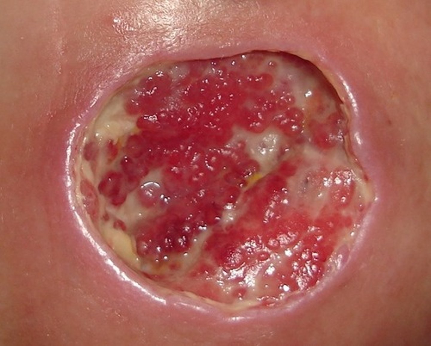 <p>rolled under edges of wound</p><p>*inhibits healing</p>