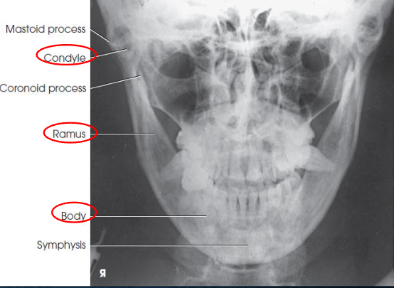 <ul><li><p>mandibular body and TMJs (condyles)</p></li><li><p>TMJs just inferior to the mastoid process</p></li><li><p>no rotation or tilt</p><ul><li><p>symmetric rami</p></li><li><p>MSP of head aligned with axis of collimated field</p></li></ul></li></ul><p></p>