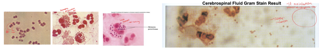 <p><span style="background-color: transparent; font-family: "Times New Roman", serif;">a. &nbsp; &nbsp; 	Morphology: Kidney bean shaped Gram-negative diplococci</span></p><p><span style="background-color: transparent; font-family: "Times New Roman", serif;">b. &nbsp; &nbsp; 	Staining reaction:&nbsp; gram neg</span></p><p><span style="background-color: transparent; font-family: "Times New Roman", serif;">c. &nbsp; &nbsp; 	Cultural requirements: Fastidious bacteria but will grow if optimized for temperature at 37° C and if enhanced by 2 to 8% CO2&nbsp;</span></p><ul><li><p><span style="background-color: transparent; font-family: "Times New Roman", serif;">&nbsp;pathogenic strains will not grow below 25° C or room temp</span></p></li><li><p><span style="background-color: transparent; font-family: "Times New Roman", serif;">&nbsp;are quite sensitive to cold temperatures and will die for refrigerated or sample is plated onto media just removed from the refrigerator</span></p></li><li><p><span style="background-color: transparent; font-family: "Times New Roman", serif;">Incubator with CO2 filled as a chamber from external Source or candle Extinction jar is often used</span></p></li><li><p><span style="background-color: transparent; font-family: "Times New Roman", serif;">&nbsp;highly susceptible to adverse conditions such as drying, chilling, sunlight, pH extremes</span></p></li><li><p><span style="background-color: transparent; font-family: "Times New Roman", serif;">Of utmost importance there must be minimal to no delay of culture of samples after collection&nbsp;</span></p></li><li><p><span style="background-color: transparent; font-family: "Times New Roman", serif;">Enriched media is required: chocolate agar ( blood agar that has been heated to humalyze rbc, free hemoglobin contains Fe which require is required for growth) or chocolate agar-based media</span></p><ul><li><p><span style="background-color: transparent; font-family: "Times New Roman", serif;">commonly used media for isolates of pathogenic neisseria is Taylor Martin (TM) agar→ Chocolate-based agar with some antimicrobics added as in VCN agar which is another similar concept that only allows pathogenic bacteria to grow&nbsp;</span></p></li><li><p><span style="background-color: transparent; font-family: "Times New Roman", serif;">VCN agar→Chocolate agar modified by addition of antibiotics: Vancomycin to inhibit gram-positive bacteria, colistin to inhibit gram-negative bacteria rods, nystatin to inhibit yeast</span></p></li></ul></li></ul><p></p>