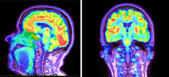 <p>produces color computer graphics.visual display of brain activity that detects where a radioactive form of glucose goes while brain performs a task—-FUCNTION</p>