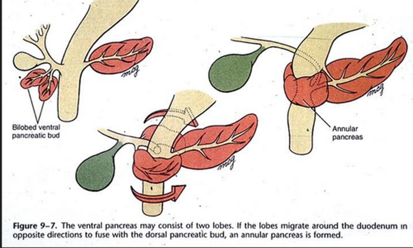 <p>abnormal migration of the ventral pancreatic bud</p><p>- can compress duodenum, causing vomiting</p>
