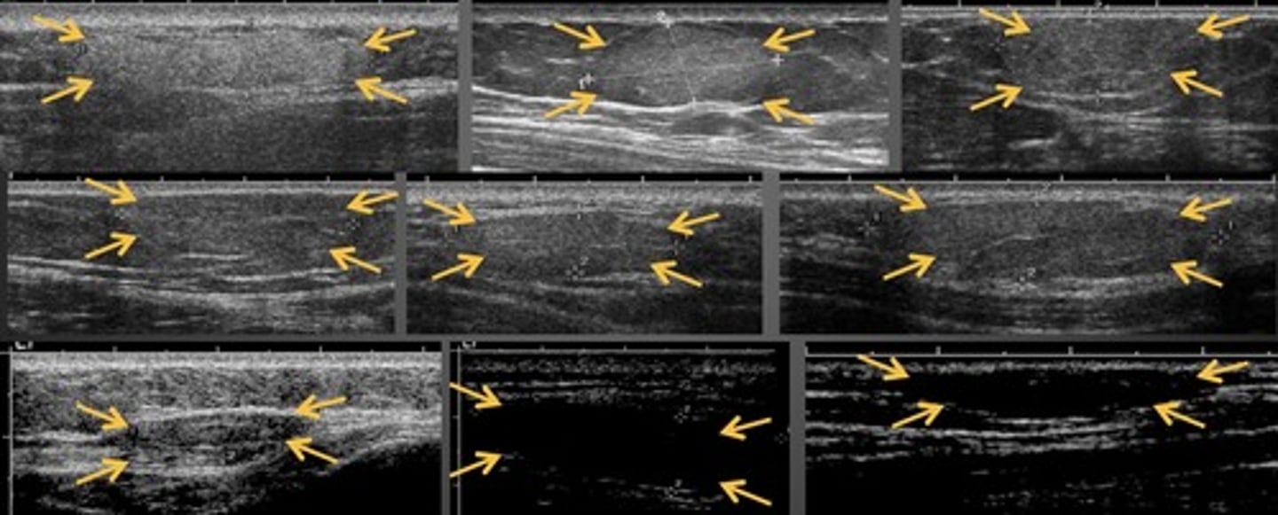 <p>Most common soft tissue tumor</p><p>Subcutaneous</p><p>Smooth borders</p><p>No shadowing</p><p>Minimal/no color flow</p><p>Somewhat compressible</p><p>Range in echogenicity</p>
