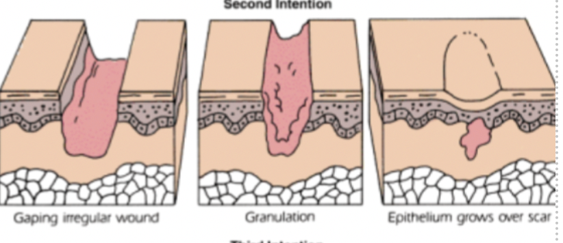 <ul><li><p><span>Seen with abscess&nbsp;</span></p></li><li><p><span>Pressure ulcer&nbsp;</span></p></li></ul>