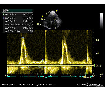 <p>This Doppler inflow image of the mitral valve is consistent with:</p><p></p><p>Restrictive physiology</p><p></p><p>Dilated cardiomyopathy</p><p>&nbsp;</p><p>Hypertrophic cardiomypathy</p><p>&nbsp;</p><p>Pericarditis</p>