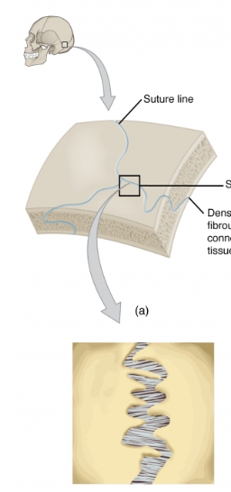 <p>a type of fibrous joint found between the bones of the skull, allowing minimal movement and providing stability. </p>