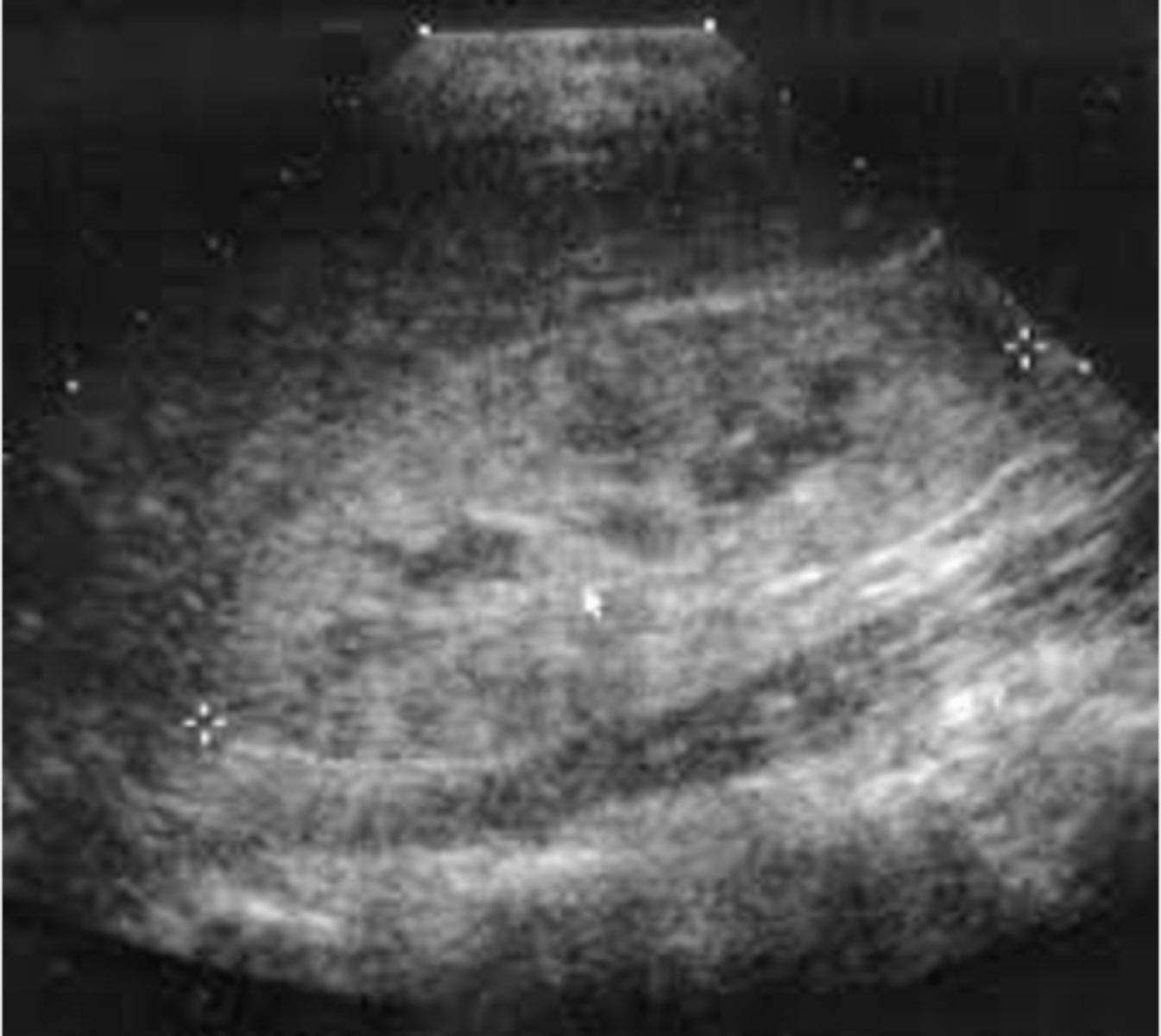 <p>Nephronophthisis (NPH) appears sonographically as small ___ kidneys with multiple cysts measuring less than ___ </p>
