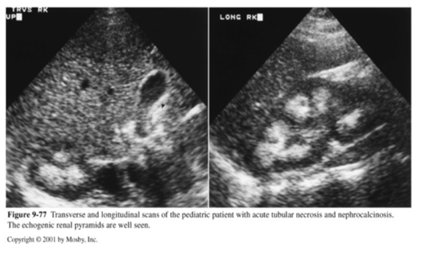 <p>-enlarged kidneys</p><p>-hyperechoic pyramids</p><p>-can be reversed with medical treatment</p>