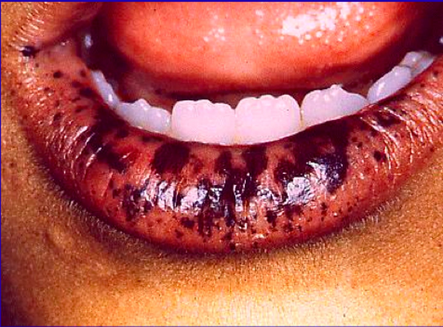 <p>pigmented macules on the lips.</p><p>Assoc with GI cancer and polyps</p>