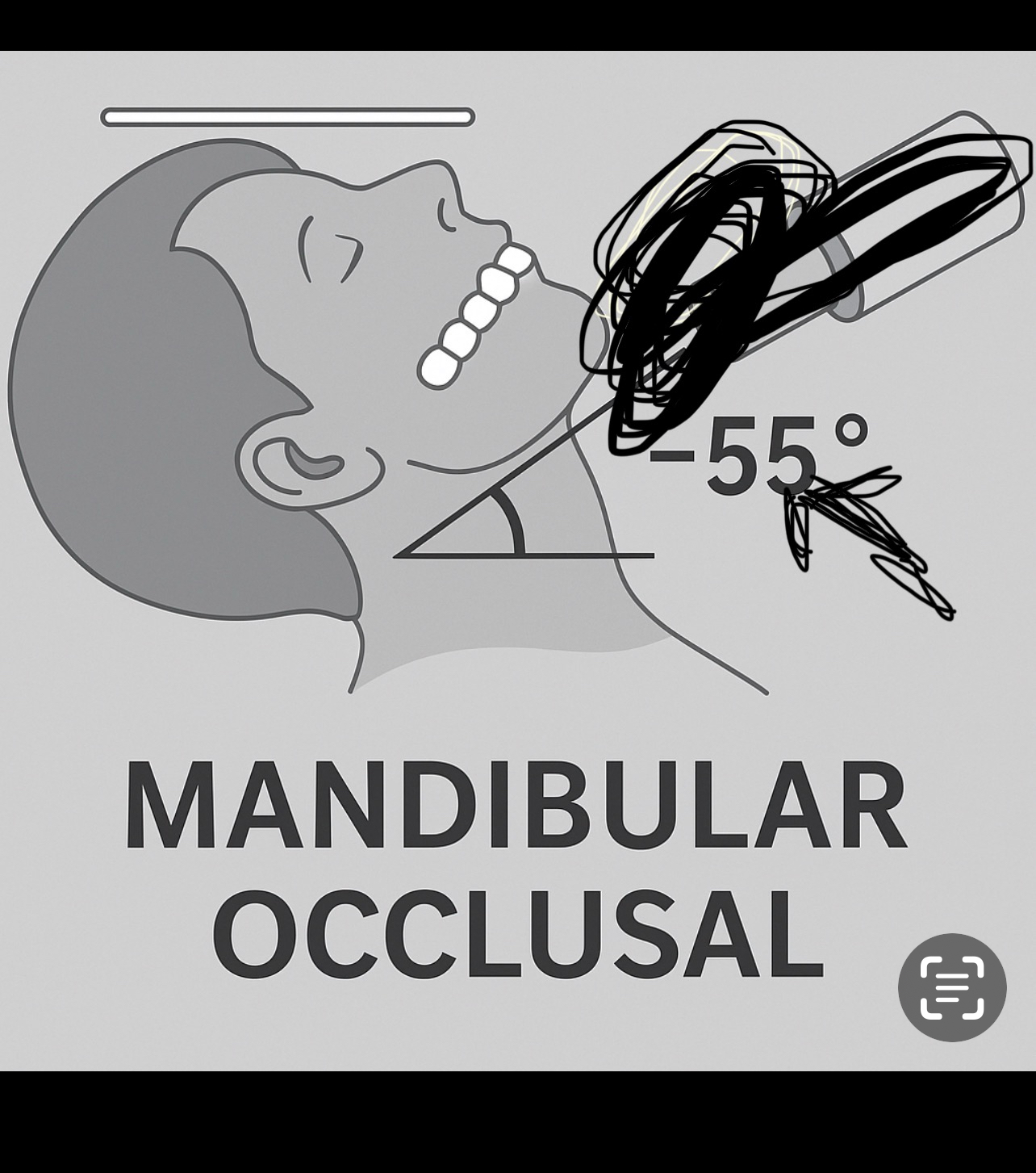 <p>head is tilted backward.</p><p>Negative 55° vertical angulation.</p><p>Through the chin</p>